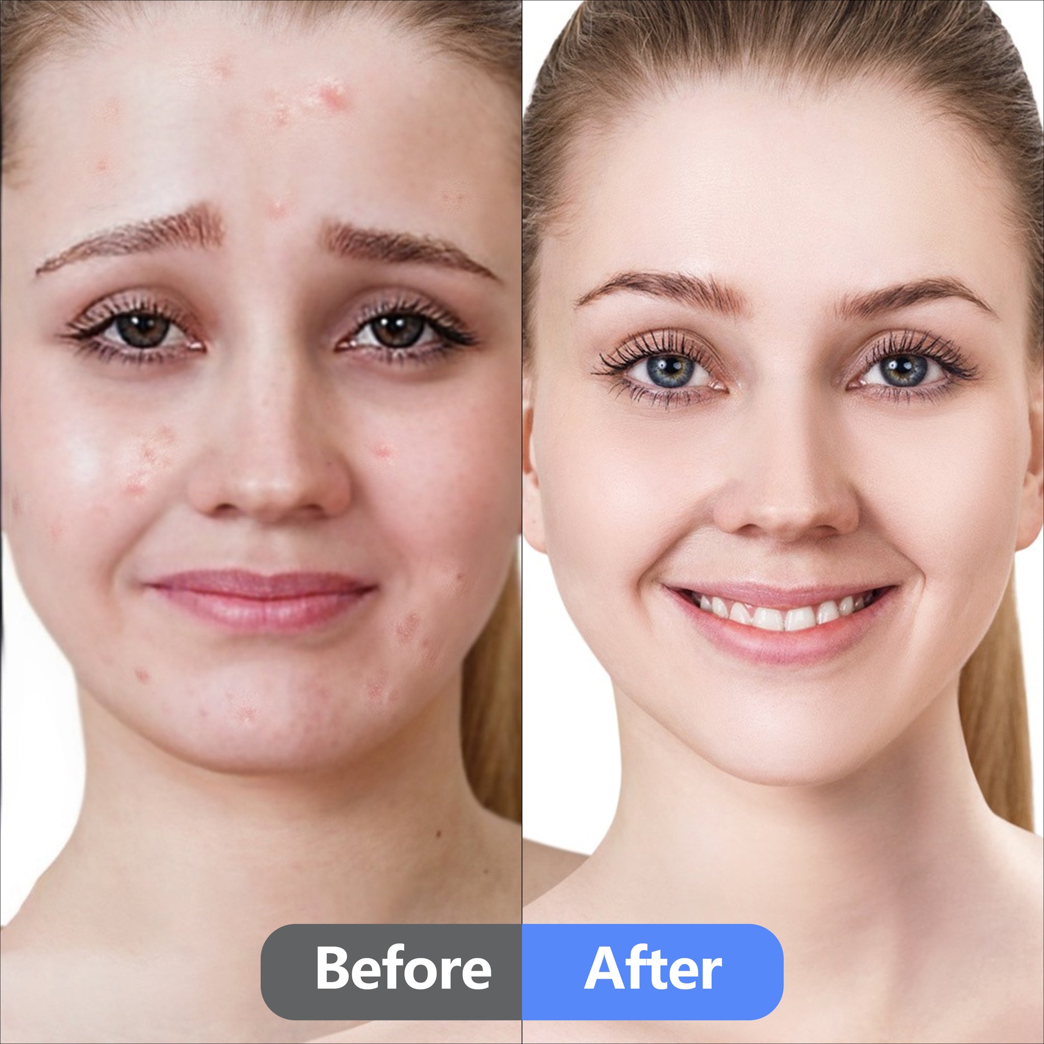 Eidersoft Acne Pimple Patch Disposable Acne Spot Treatment - Eidersoft